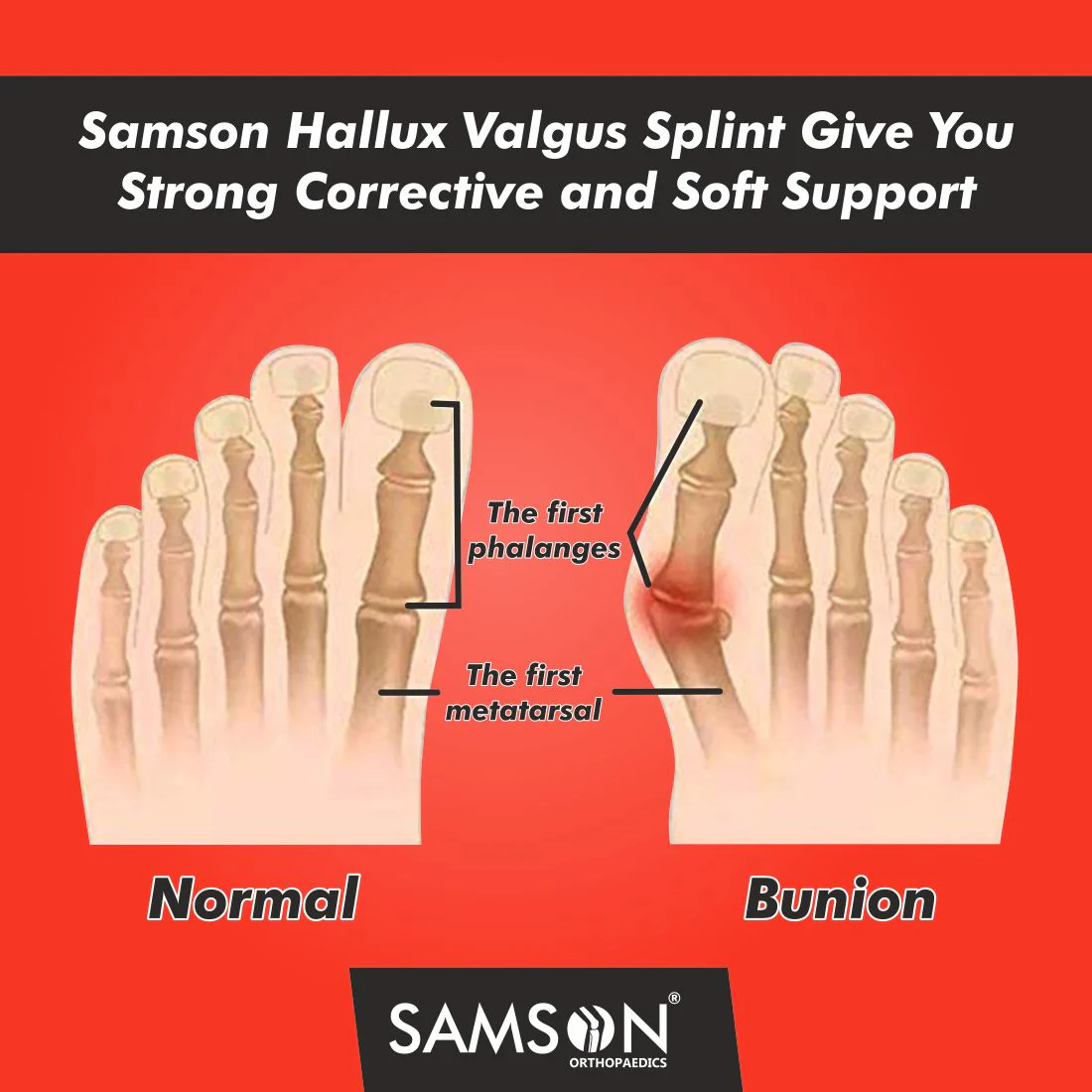 SAMSON Hallux Valgus Splint (Single) | Bunion Corrector, Toe Straightener & Fracture Support for Pain Relief - Image 3